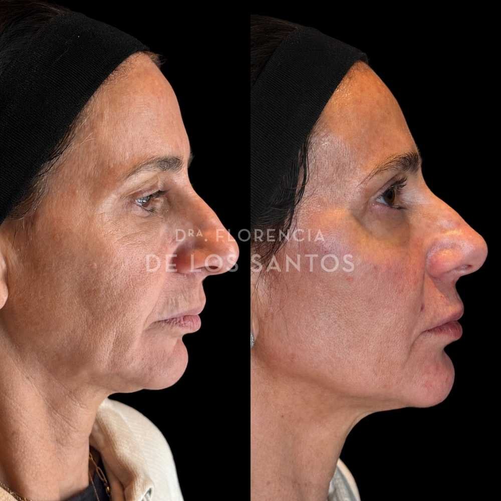 Armonización Facial Biostructure Dra Florencia de los Santos Medicliniq31