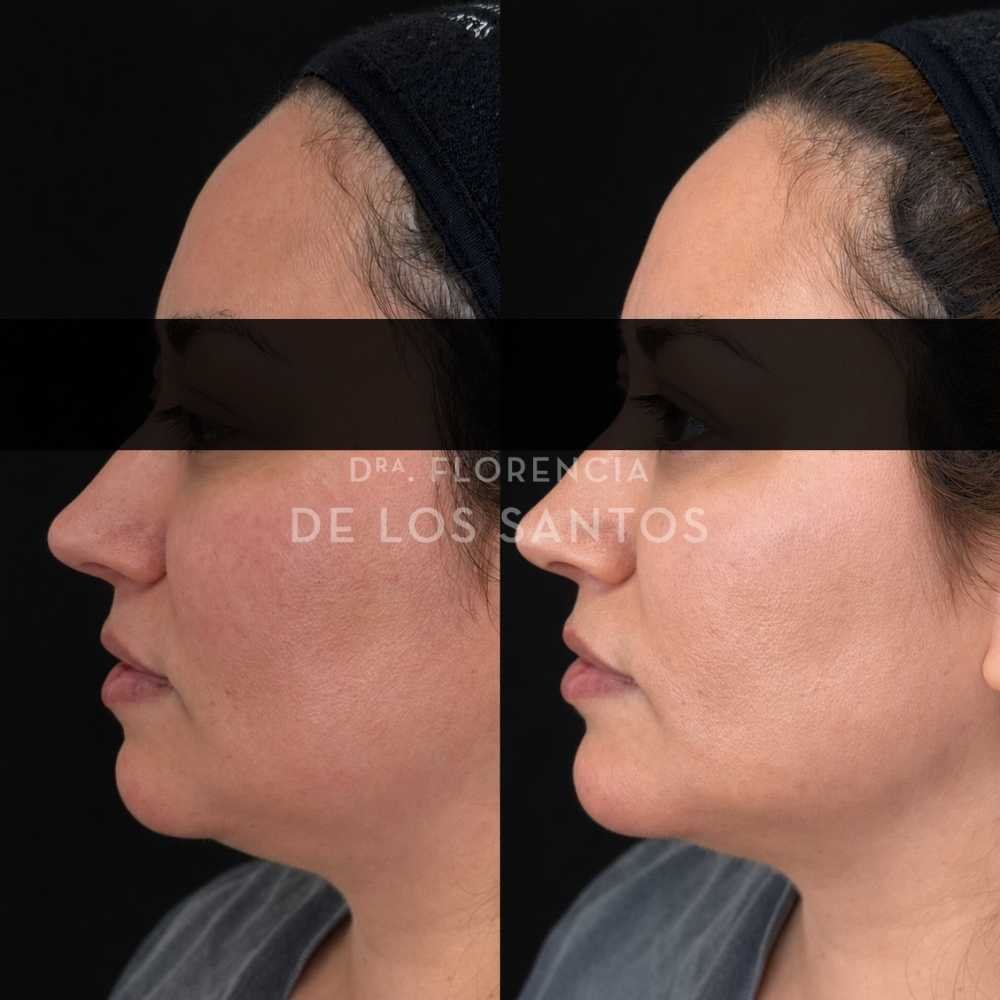 Armonización Facial Biostructure Dra Florencia de los Santos Medicliniq32