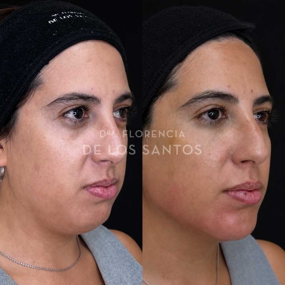Armonización Facial Biostructure Dra Florencia de los Santos Medicliniq33