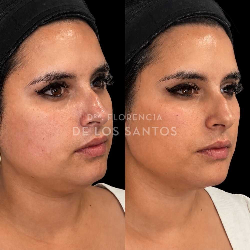 Armonización Facial Biostructure Dra Florencia de los Santos Medicliniq34