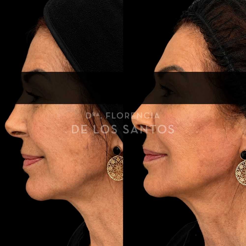 Armonización Facial Biostructure Dra Florencia de los Santos Medicliniq35