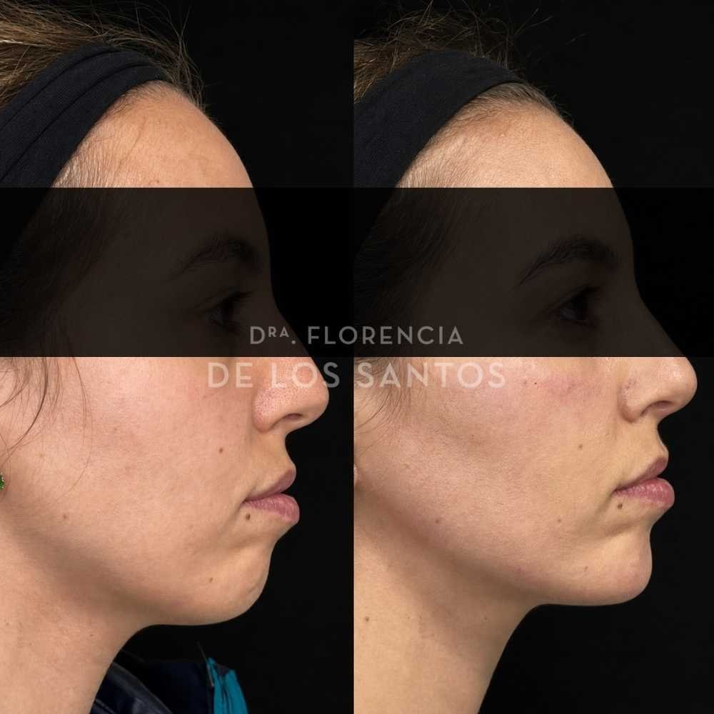 Armonización Facial Biostructure Dra Florencia de los Santos Medicliniq36