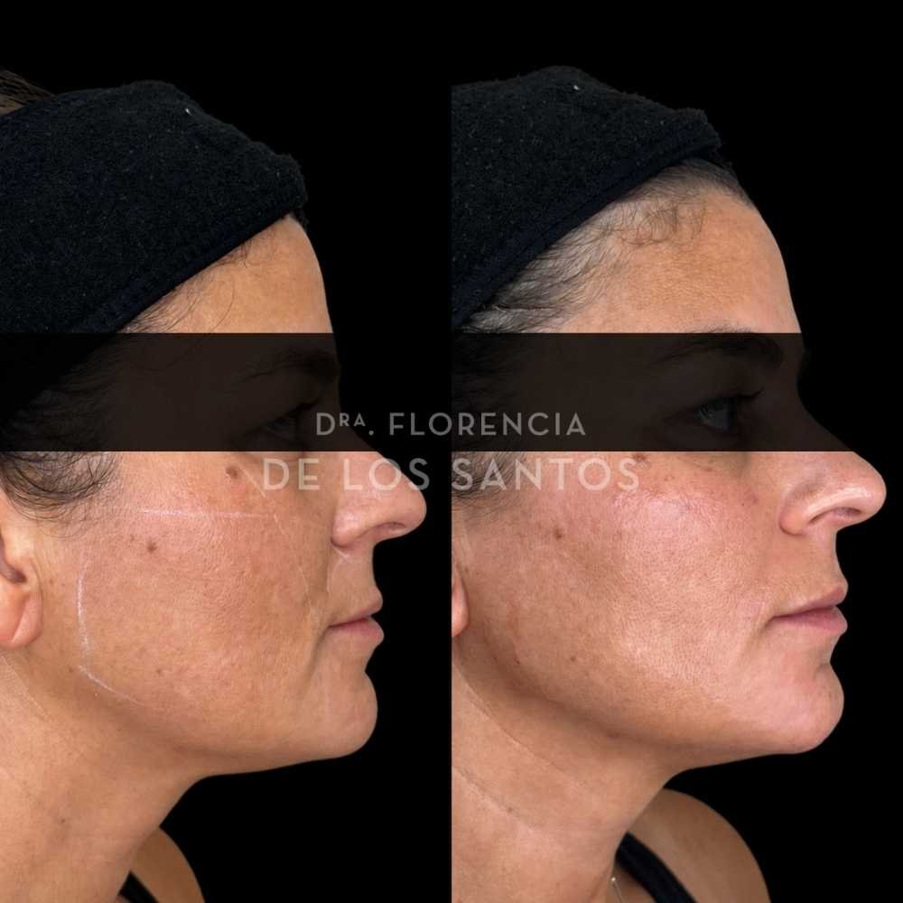 Armonización Facial Biostructure Dra Florencia de los Santos Medicliniq37