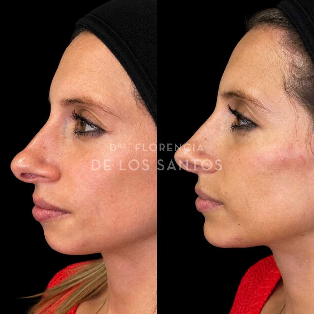 Armonización facial manchas medicliniq montevideo
