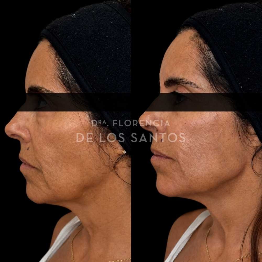 Armonización facial manchas medicliniq montevideo