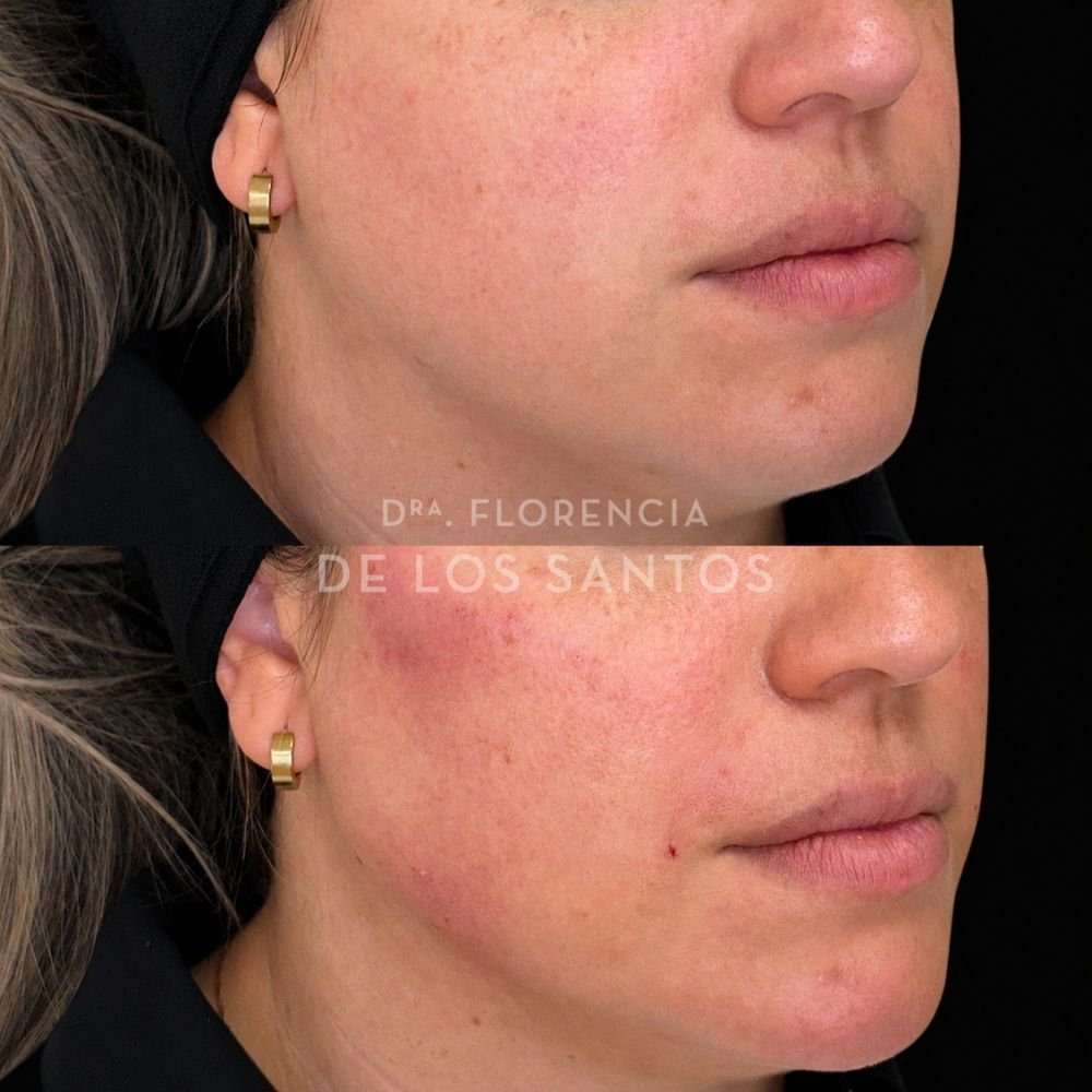 Armonización facial manchas medicliniq montevideo