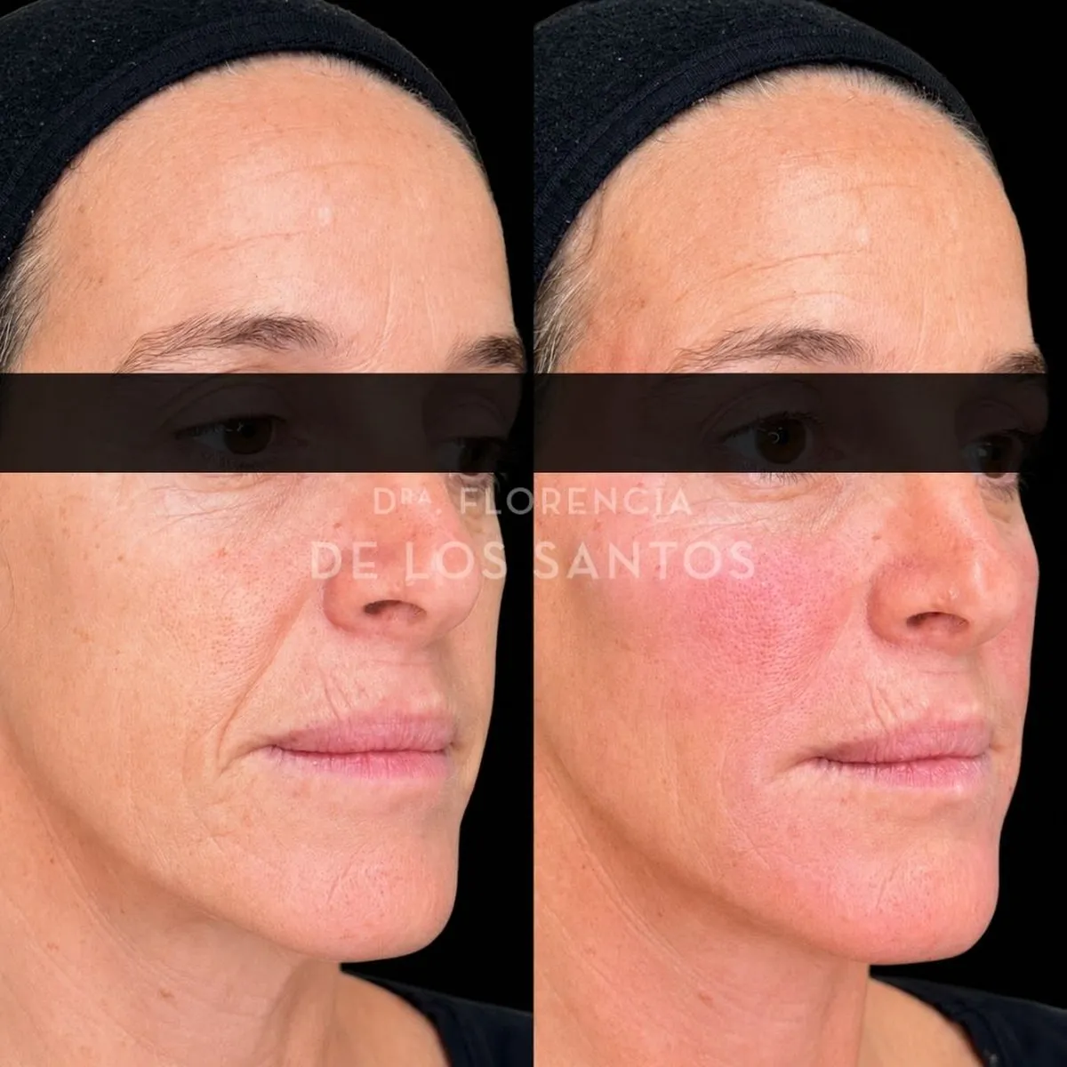 Armoozación Facial Dra Florencia de los Santos Medicliniq10