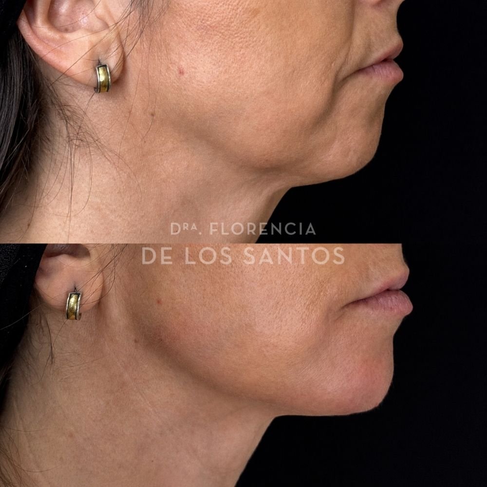 Armoozación Facial Dra Florencia de los Santos Medicliniq12