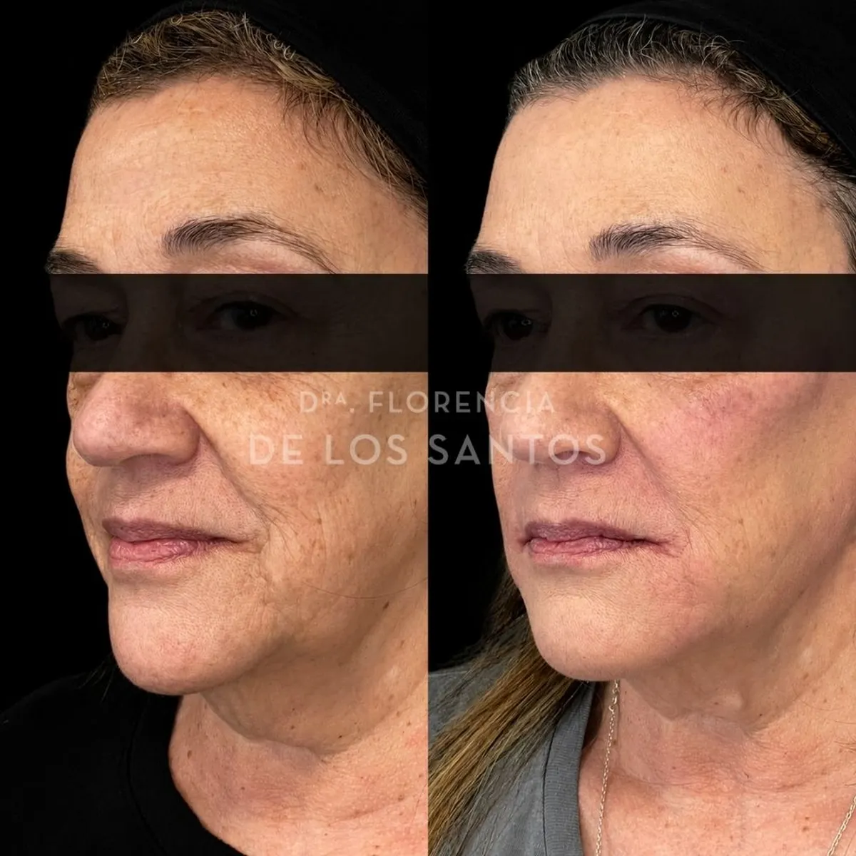 Armoozación Facial Dra Florencia de los Santos Medicliniq15