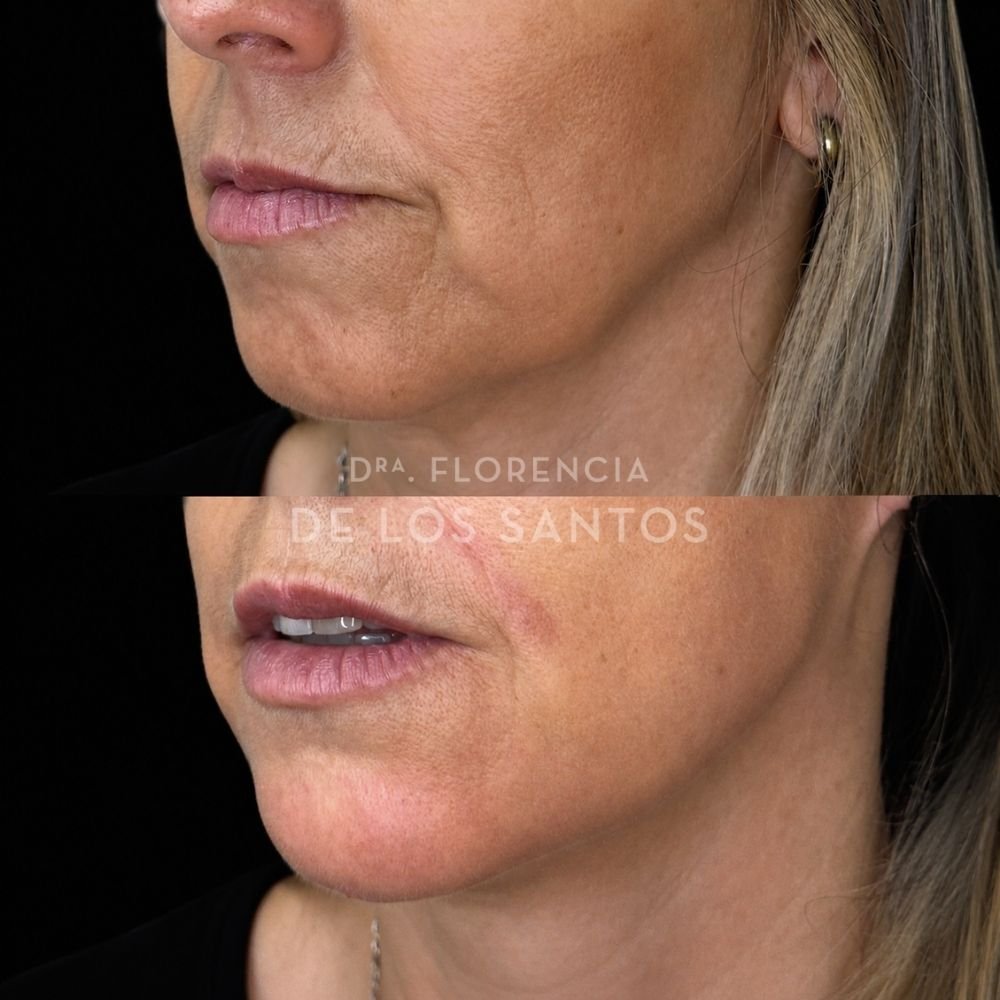 Armoozación Facial Dra Florencia de los Santos Medicliniq16