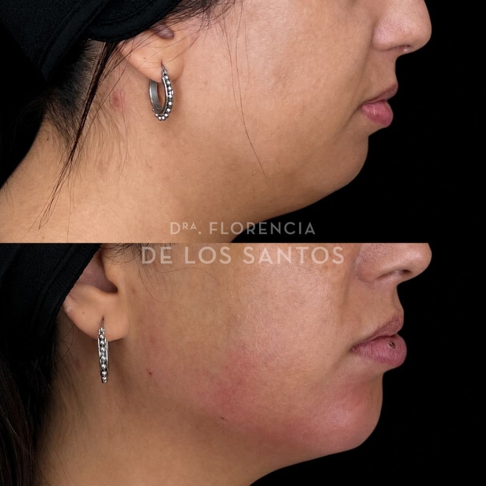 Armoozación Facial Dra Florencia de los Santos Medicliniq17