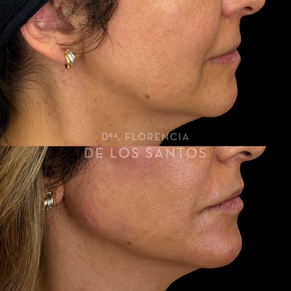 Armoozación Facial Dra Florencia de los Santos Medicliniq19
