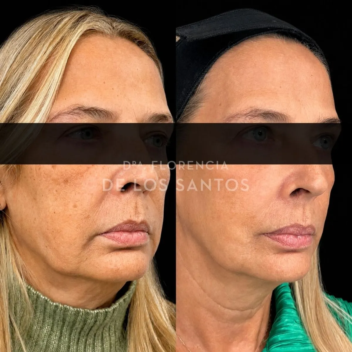 Armoozación Facial Dra Florencia de los Santos Medicliniq2