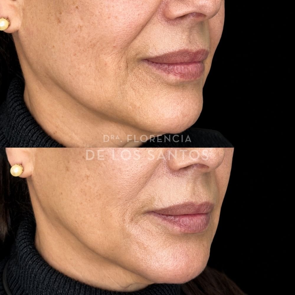 Armoozación Facial Dra Florencia de los Santos Medicliniq20