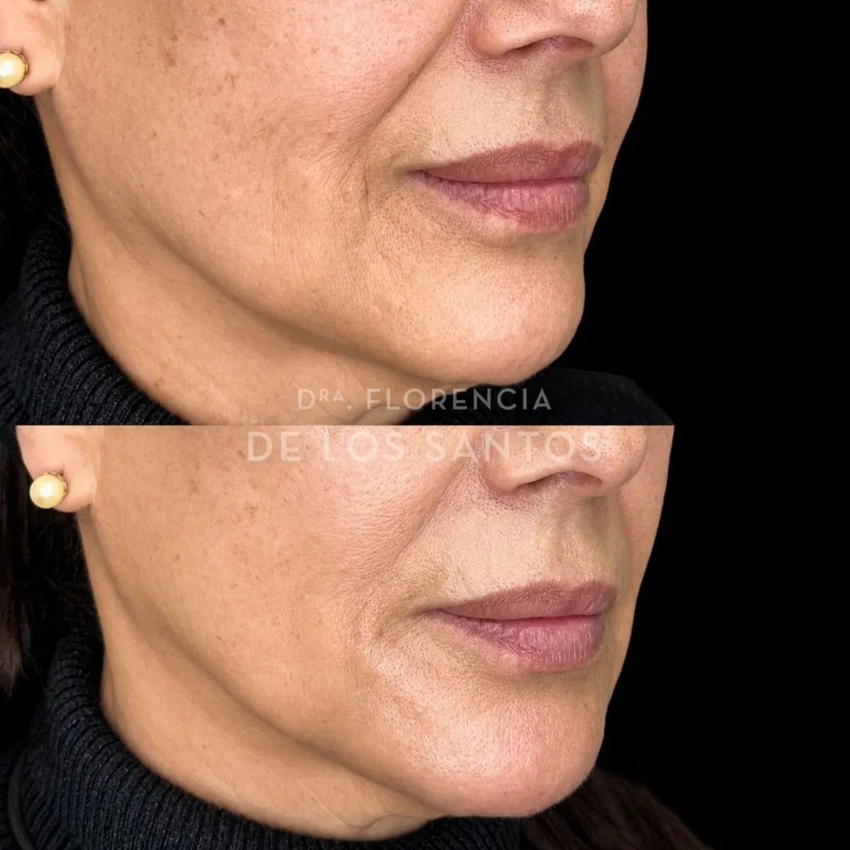 Armoozación Facial Dra Florencia de los Santos Medicliniq20