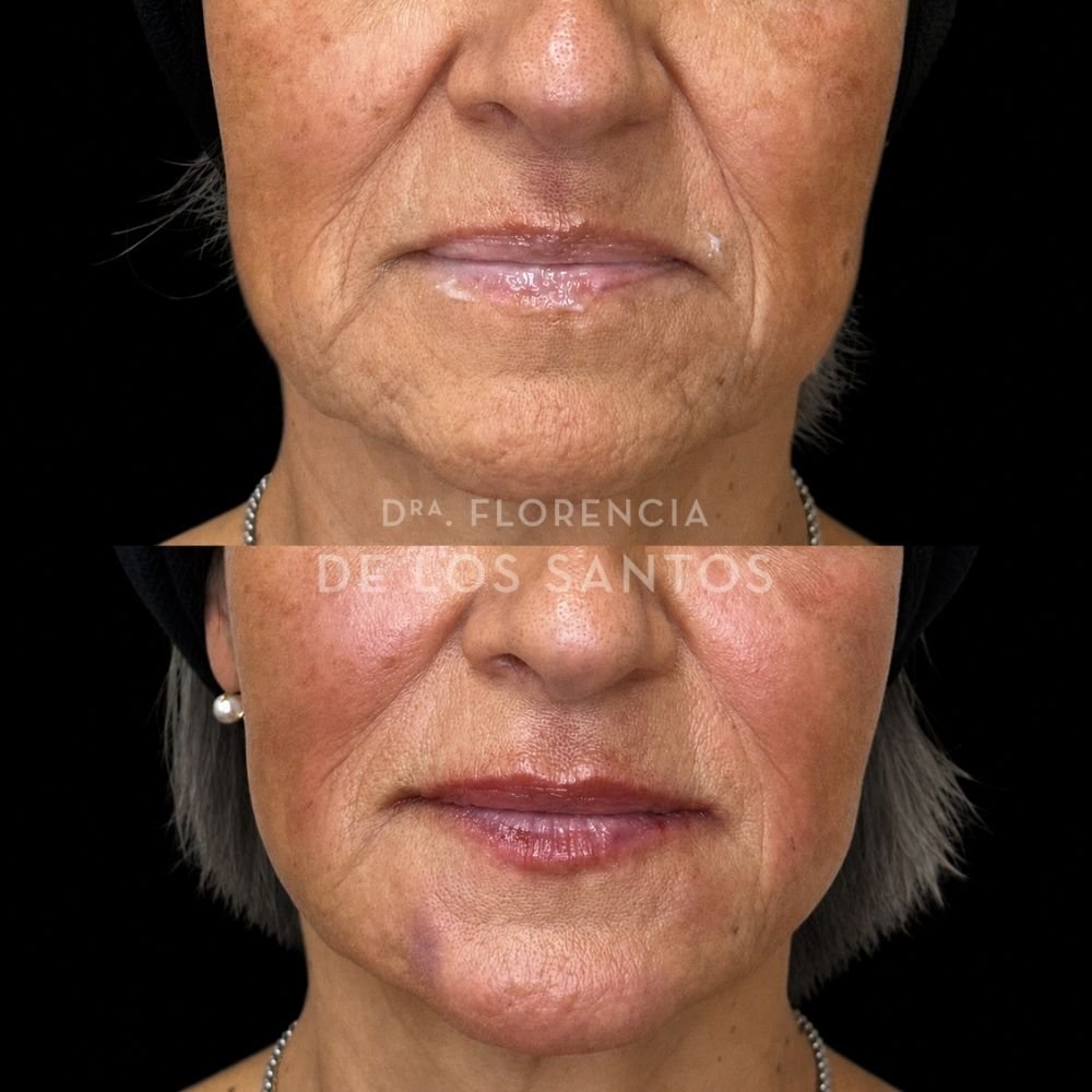 Armoozación Facial Dra Florencia de los Santos Medicliniq21