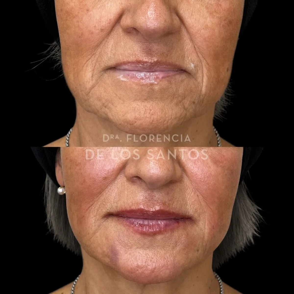 Armoozación Facial Dra Florencia de los Santos Medicliniq21