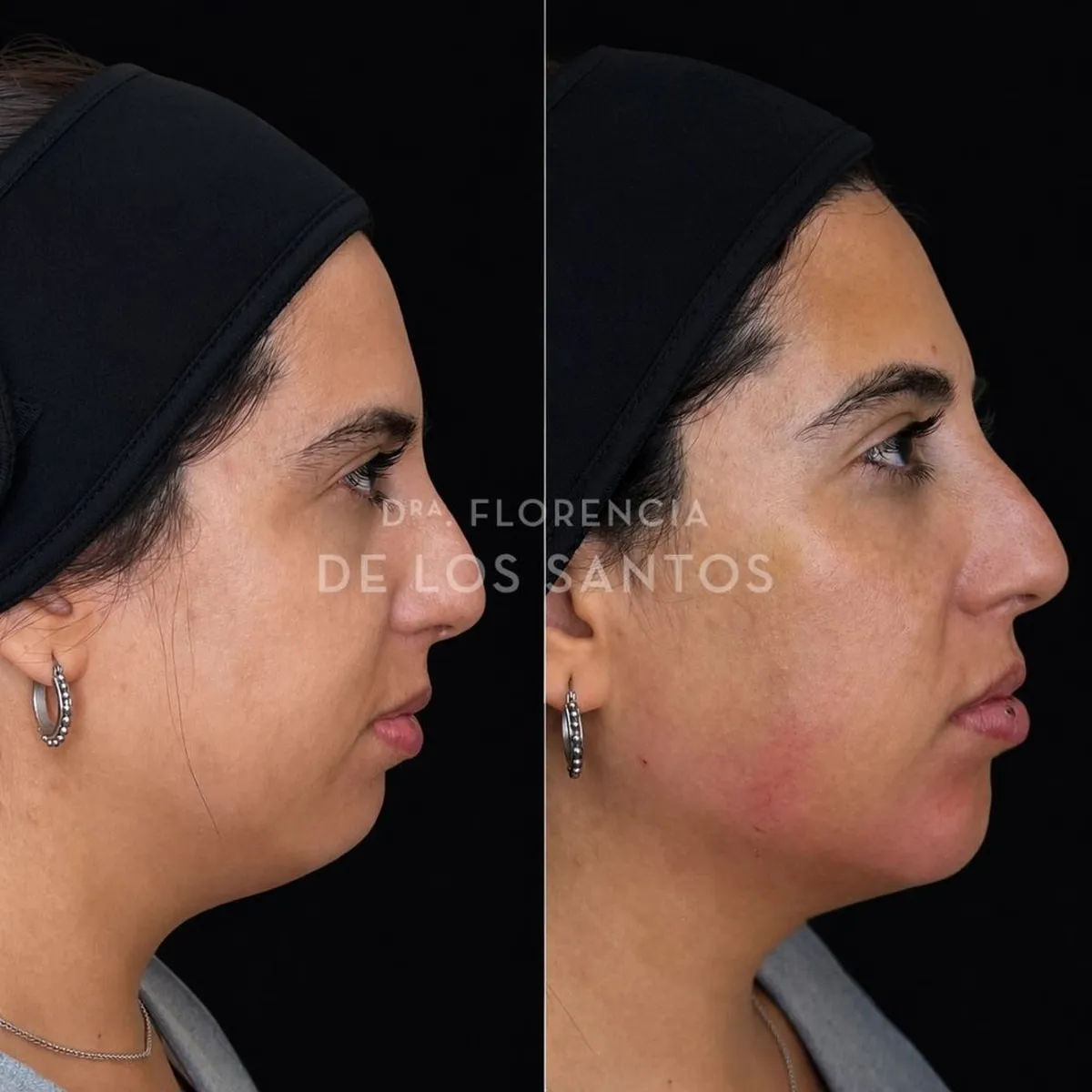 Armoozación Facial Dra Florencia de los Santos Medicliniq22