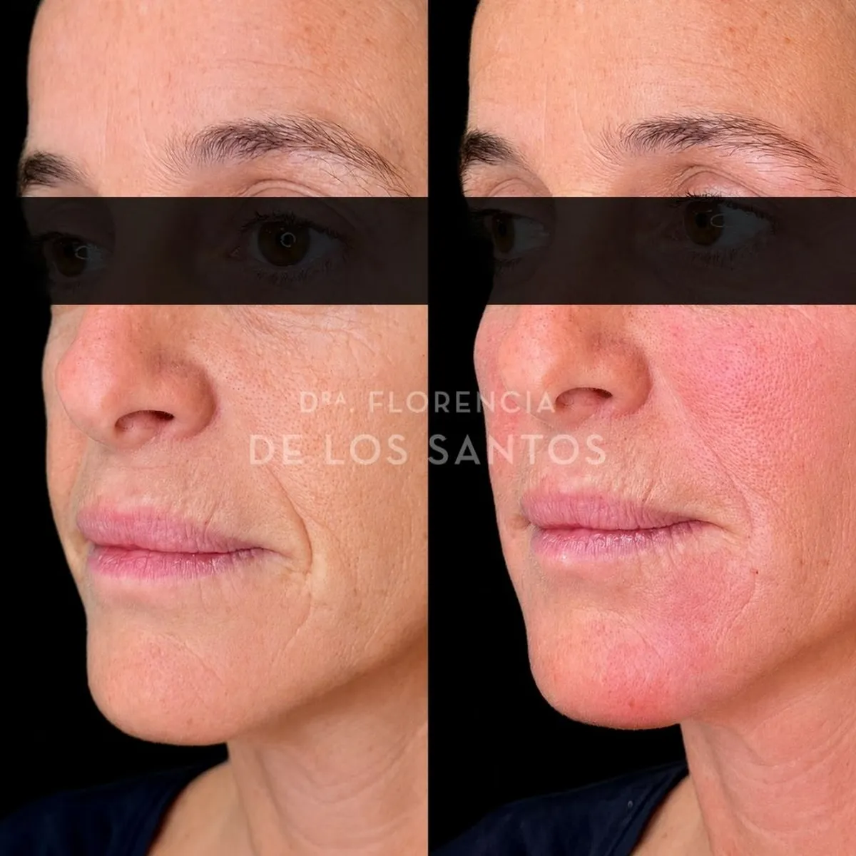 Armoozación Facial Dra Florencia de los Santos Medicliniq23