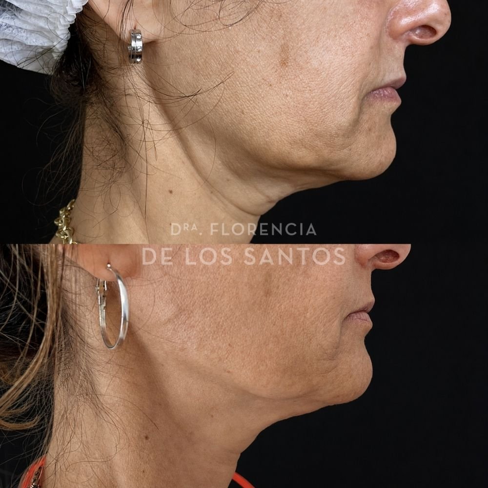 Armoozación Facial Dra Florencia de los Santos Medicliniq24