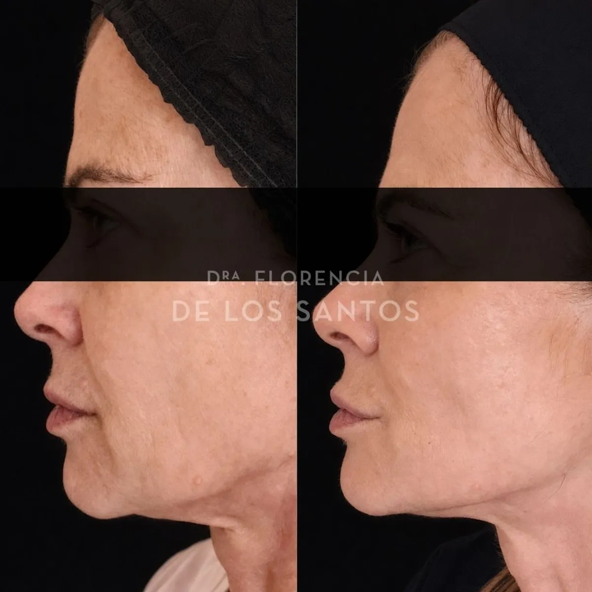 Armoozación Facial Dra Florencia de los Santos Medicliniq25