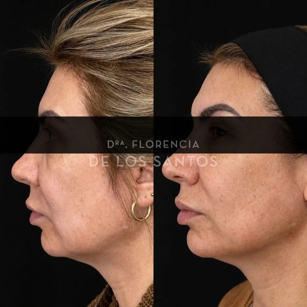 Armoozación Facial Dra Florencia de los Santos Medicliniq27