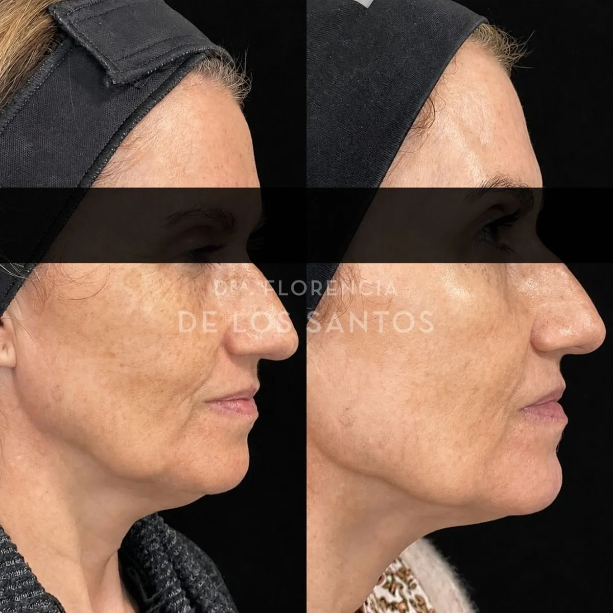 Armoozación Facial Dra Florencia de los Santos Medicliniq28