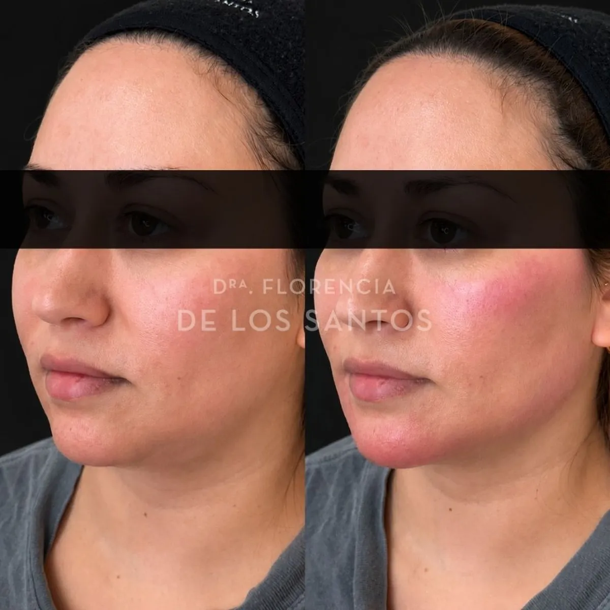 Armoozación Facial Dra Florencia de los Santos Medicliniq29