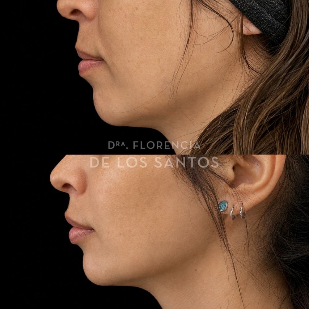 Armoozación Facial Dra Florencia de los Santos Medicliniq3