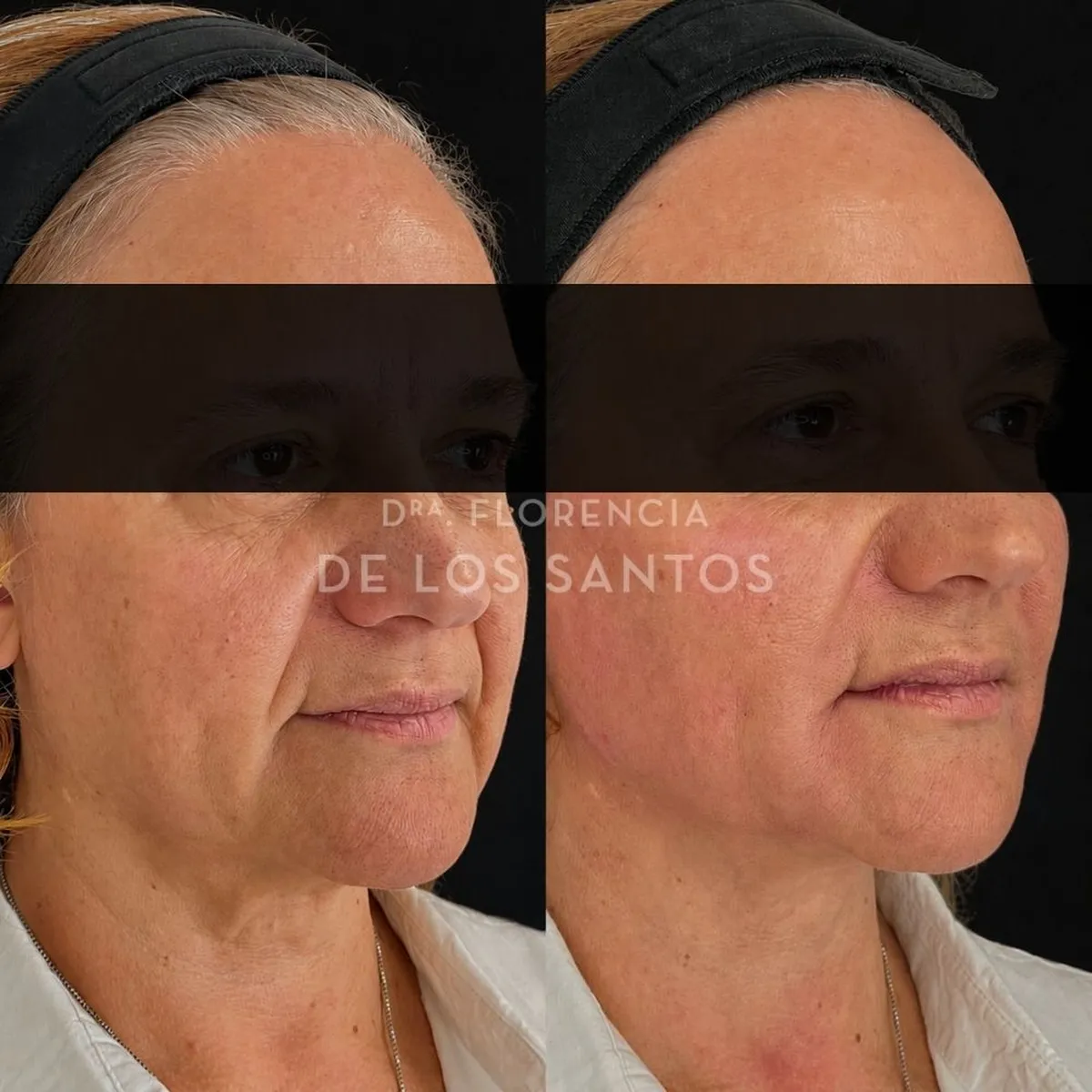 Armoozación Facial Dra Florencia de los Santos Medicliniq4