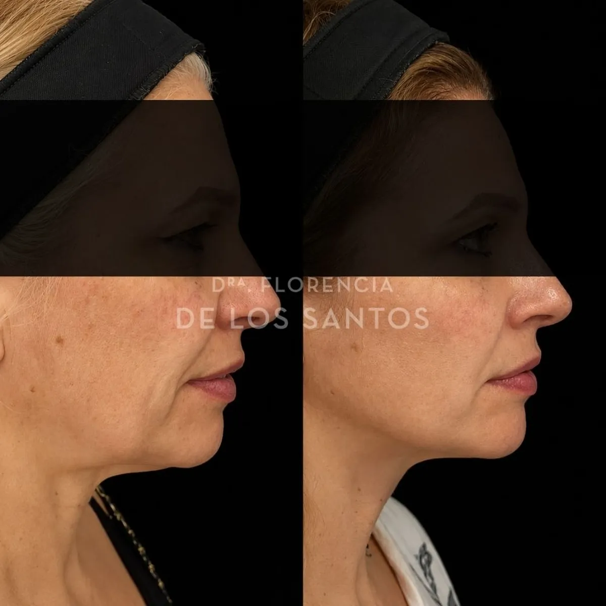 Armoozación Facial Dra Florencia de los Santos Medicliniq5
