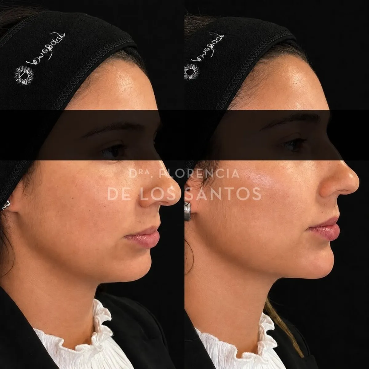 Armoozación Facial Dra Florencia de los Santos Medicliniq6