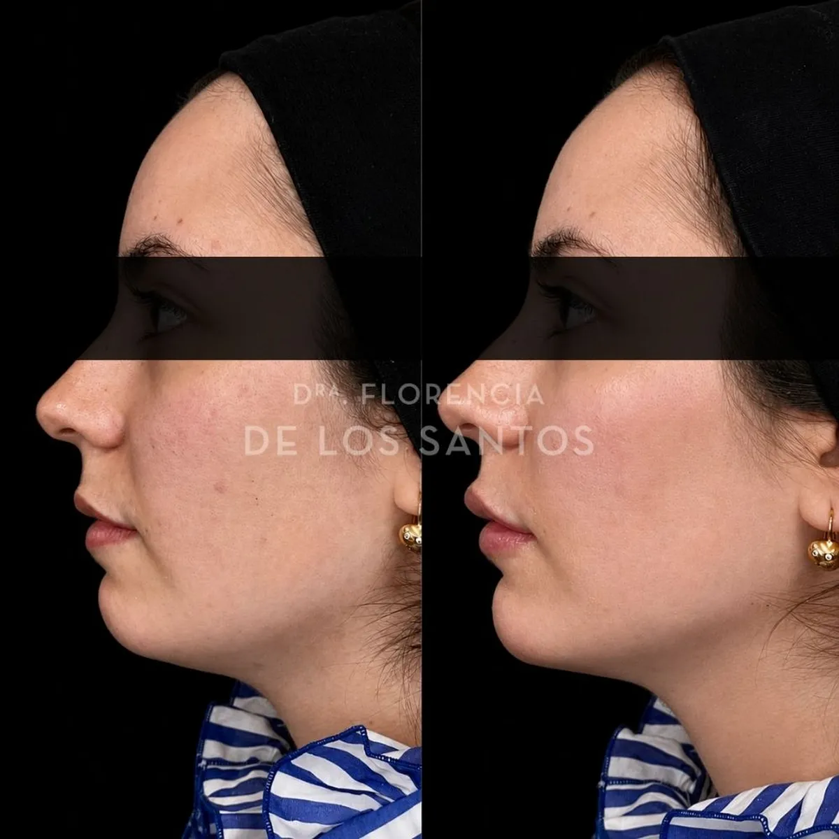 Armoozación Facial Dra Florencia de los Santos Medicliniq7