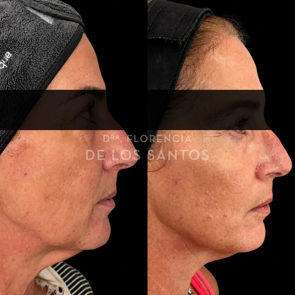 Armoozación Facial Dra Florencia de los Santos Medicliniq8