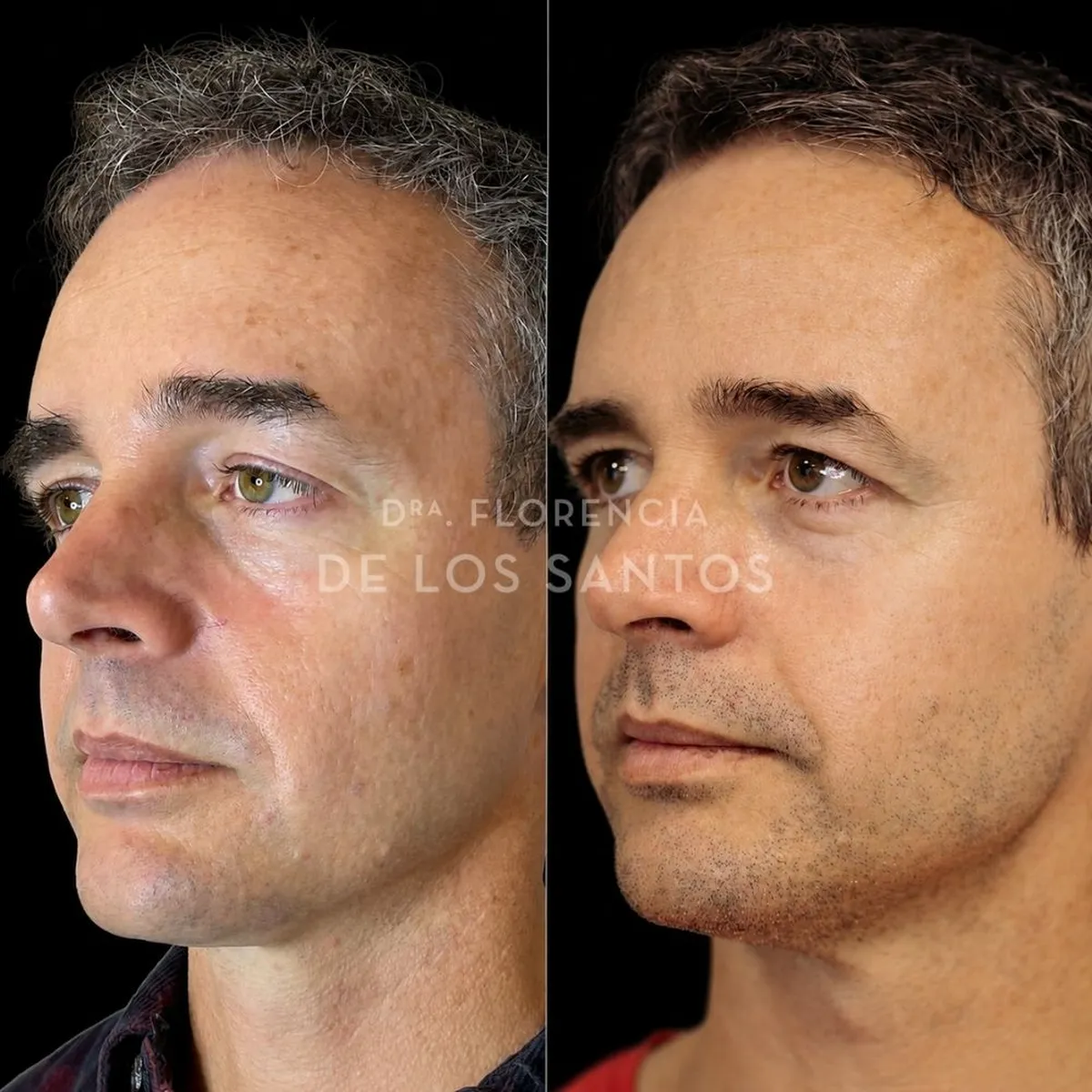 Armoozación Facial Dra Florencia de los Santos Medicliniq9