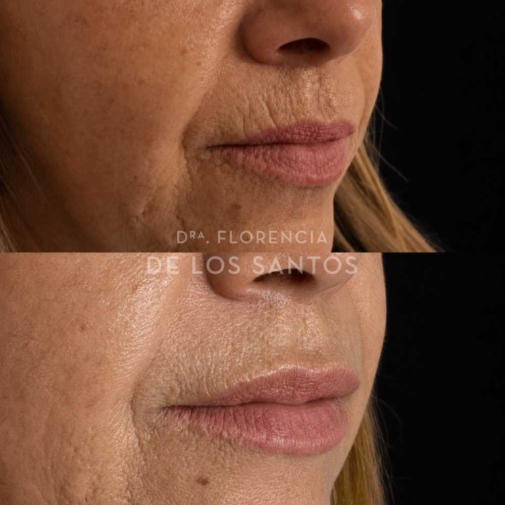 Arrugas peribucales medicliniq montevideo