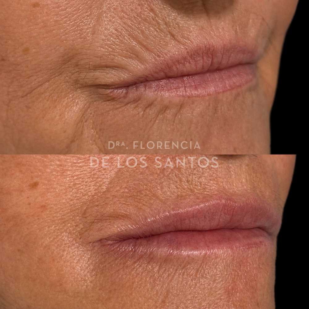 Arrugas peribucales medicliniq montevideo