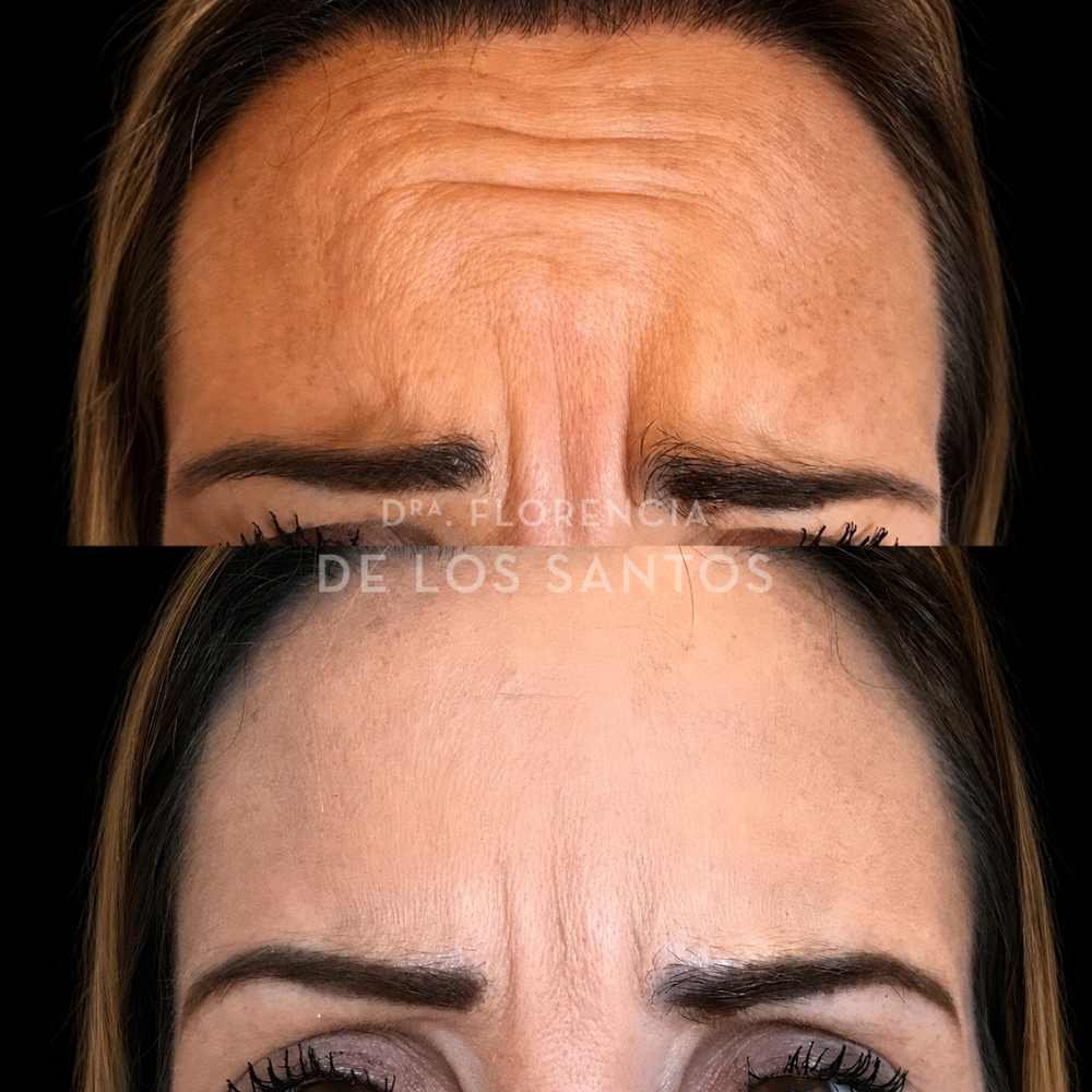 Botox manchas medicliniq montevideo