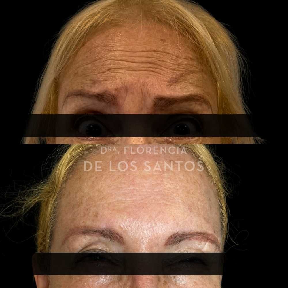 Botox medicliniq montevideo