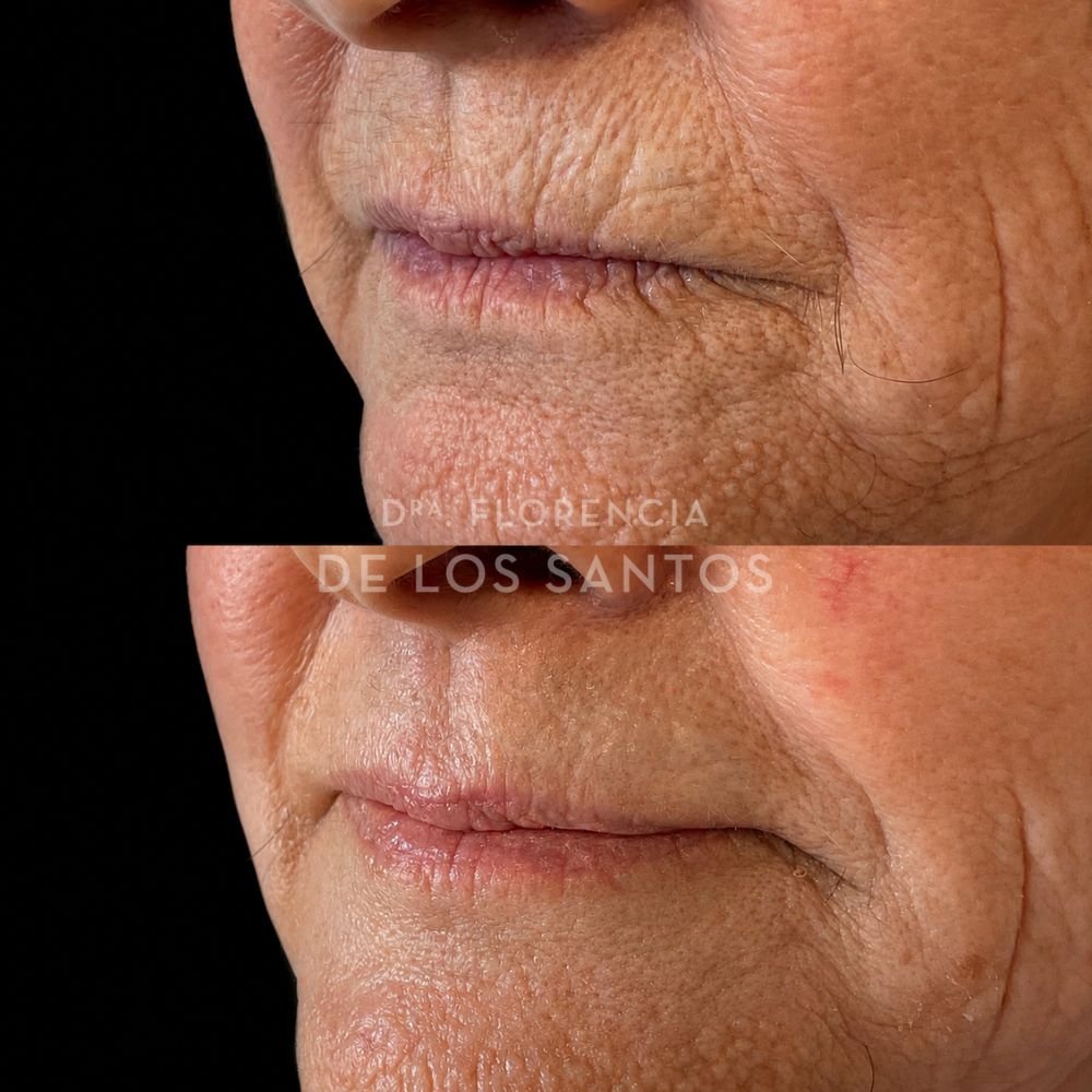Botox arrugas peribucales medicliniq dra florencia de los santos1