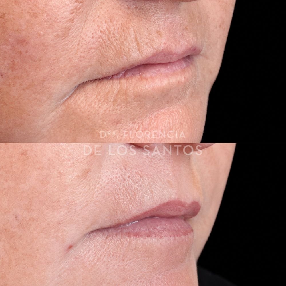 Botox arrugas peribucales medicliniq dra florencia de los santos2