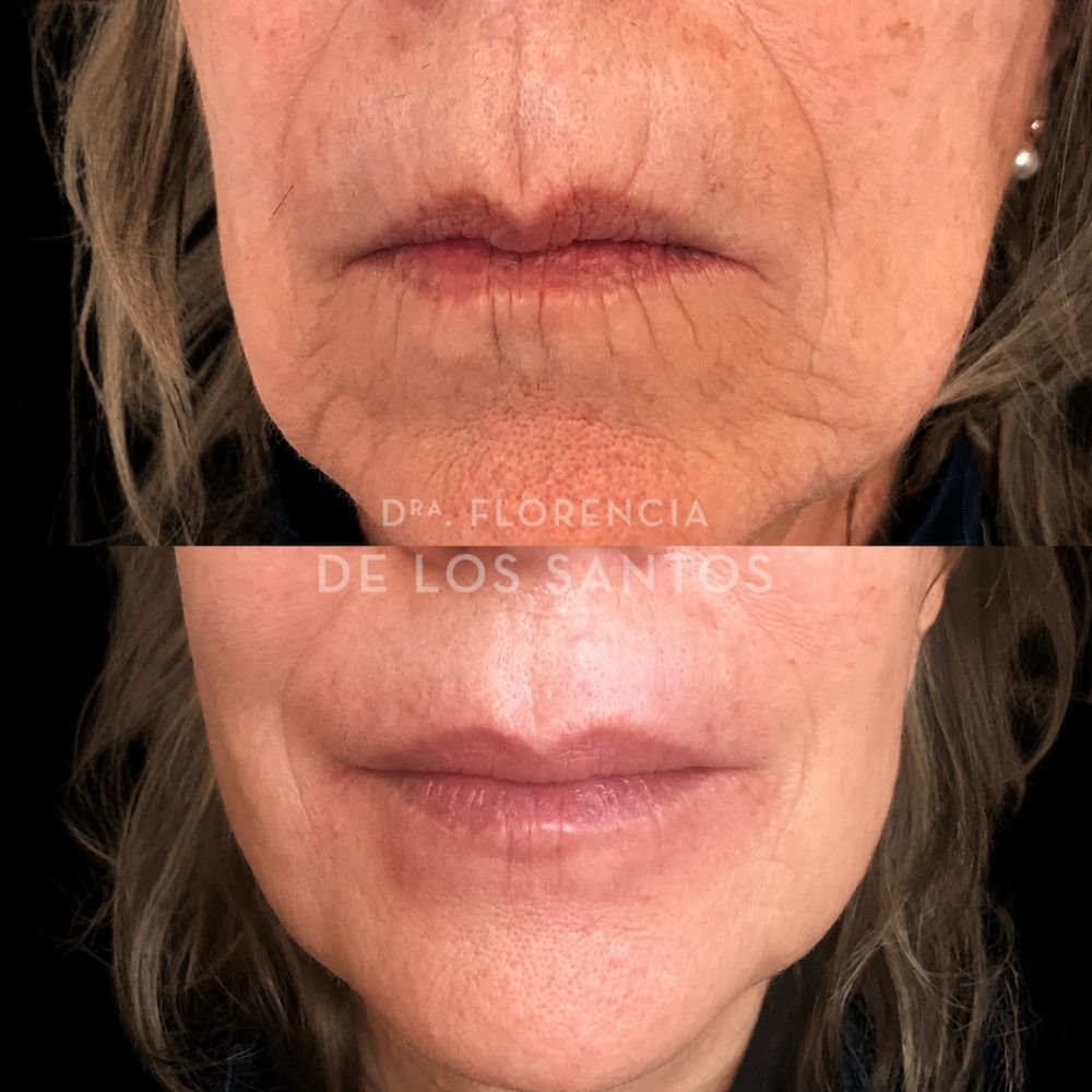 Botox arrugas peribucales medicliniq dra florencia de los santos3