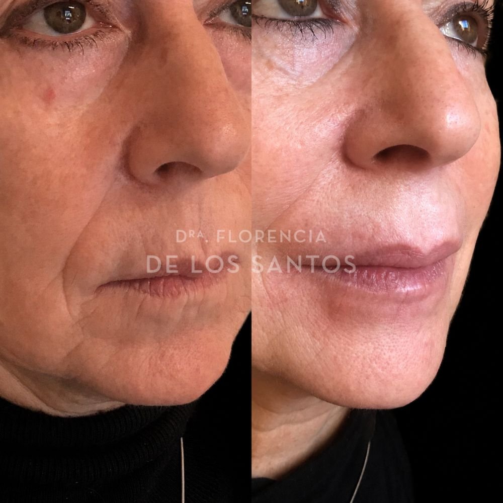 Botox arrugas peribucales medicliniq dra florencia de los santos4