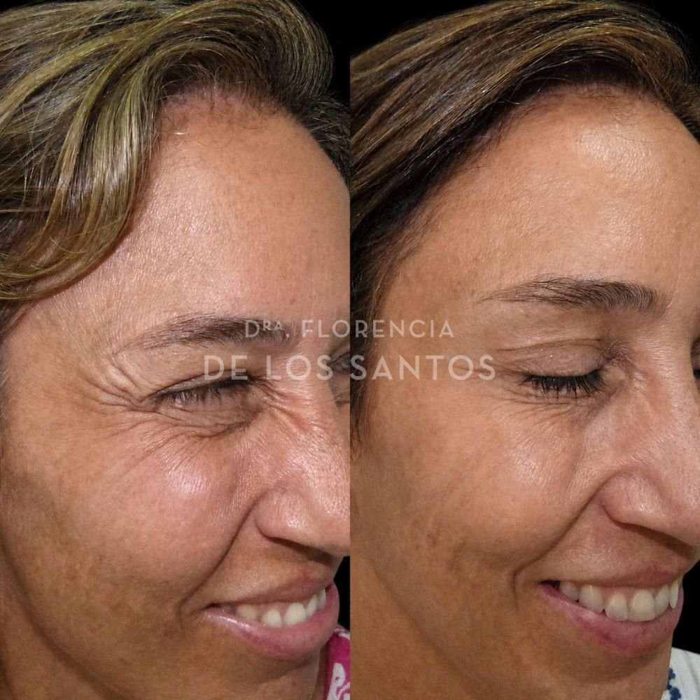 Botox toxina botulínica medicliniq dra florencia de los santos1
