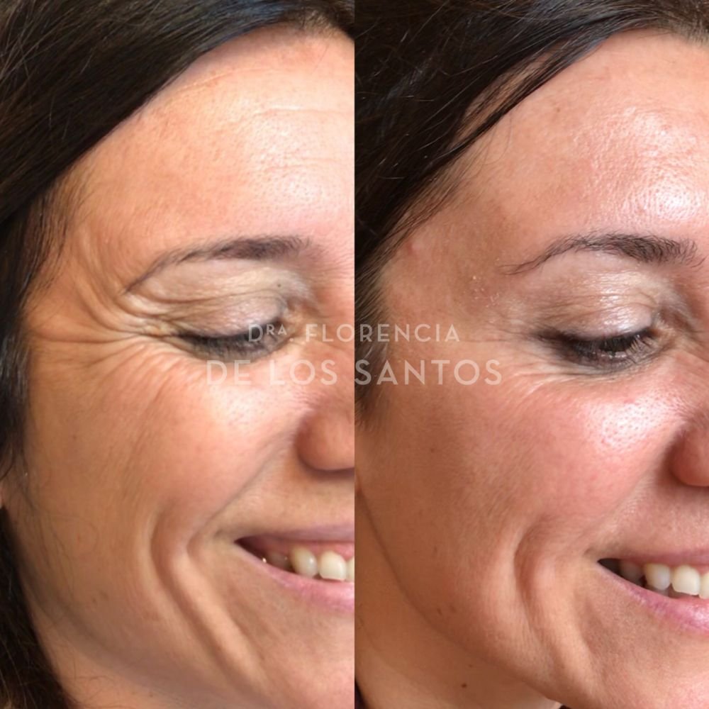 Botox toxina botulínica medicliniq dra florencia de los santos2