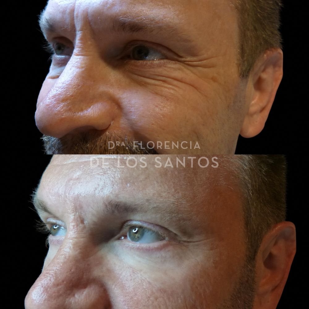 Botox toxina botulínica medicliniq dra florencia de los santos3