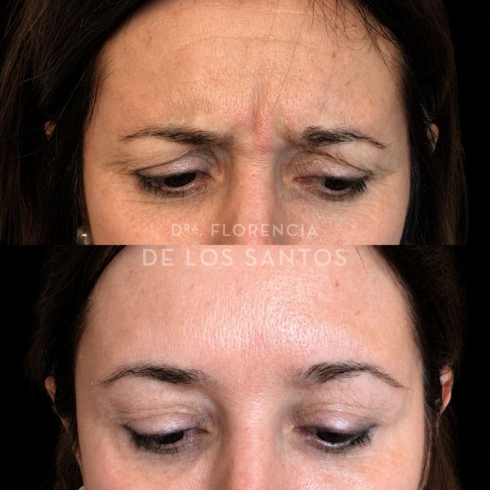 Botox toxina botulínica medicliniq dra florencia de los santos4
