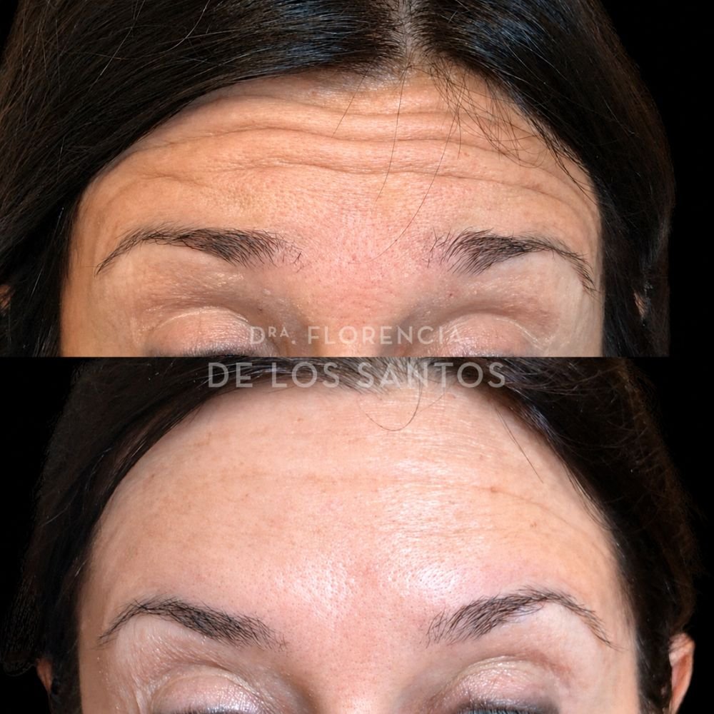 Botox