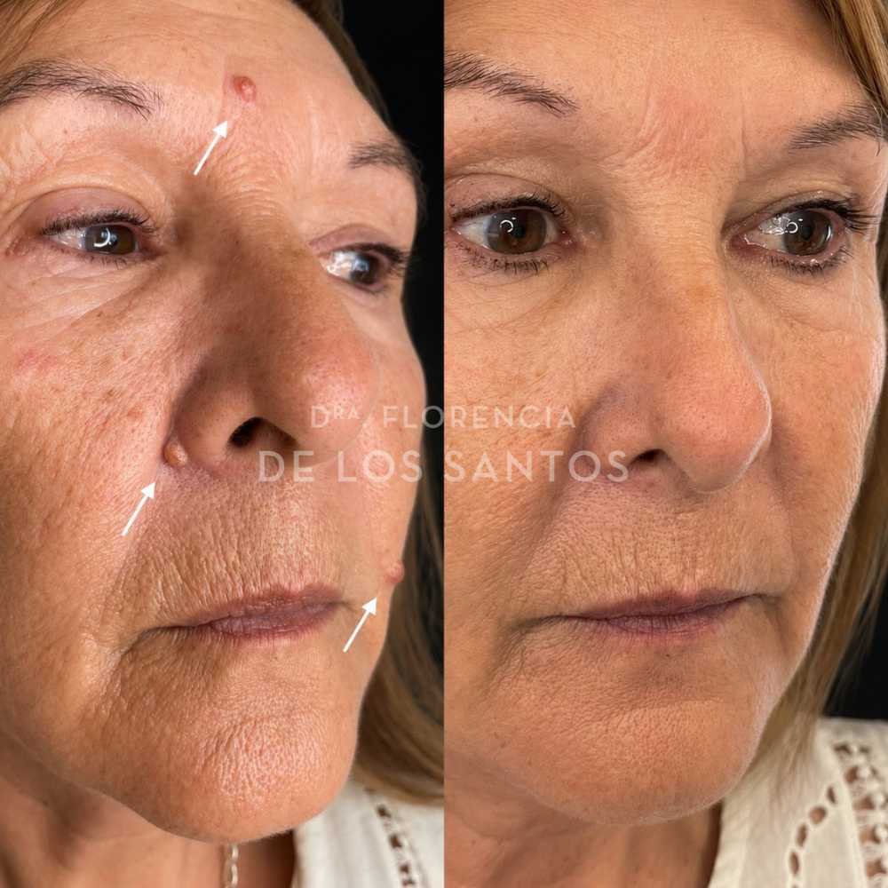 Cicatrices y lesiones de piel manchas medicliniq montevideo