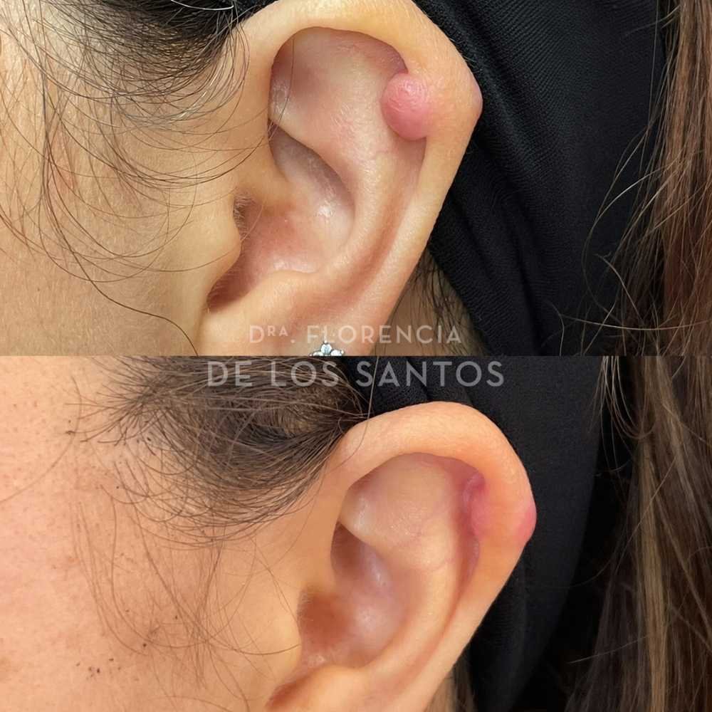 Cicatrices y lesiones de piel medicliniq montevideo